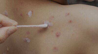 ¿Qué síntomas causa la varicela?